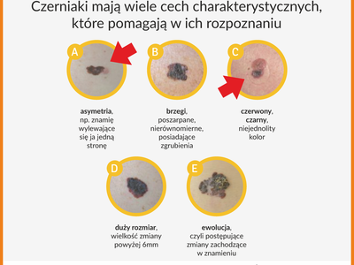 Grafika czerniaka