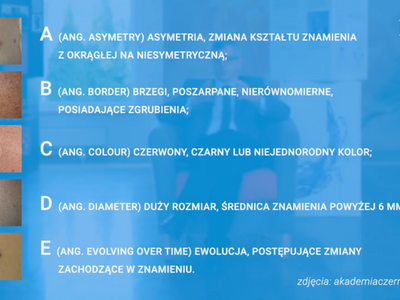 Zdjęcie dot. czerniaka